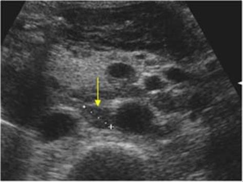 Para Aortic Lymph Nodes Ultrasound Ultrasound Images In Case 1 With A