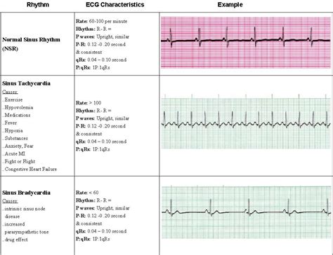ACLS EKG Rhythms
