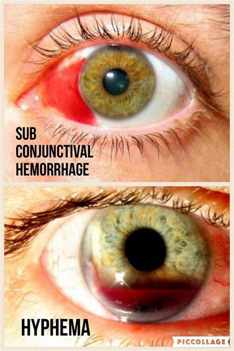 Subconjunctival Hemorrhage V Hyphema Eye Health Diseases Of The Eye