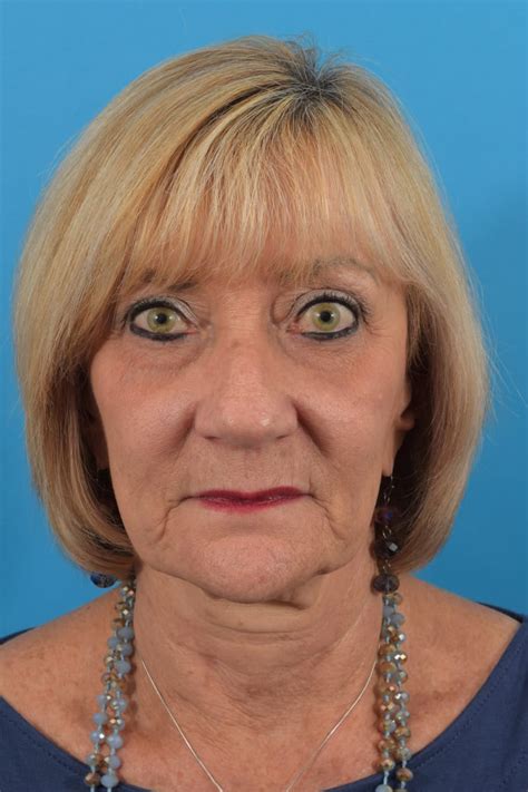 patient 36535141 blepharoplasty before and after photos frankel facial plastic surgery