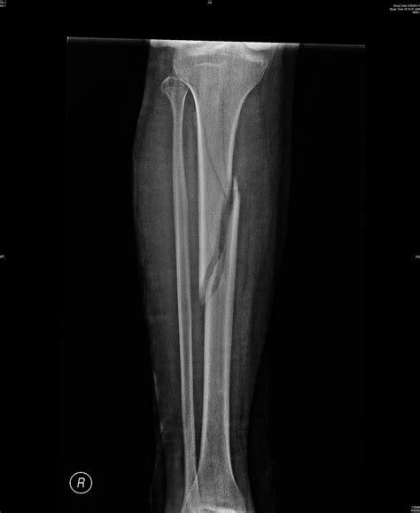 Biological Fixation Comminuted Fracture Proximal Tibia And Shaft
