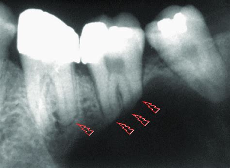 Knife Edge Root Resorption Of Involved Molars Typical Of Solid Or