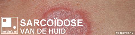 Sarcoïdose Van De Huid Huidinfonl Dermatoloog
