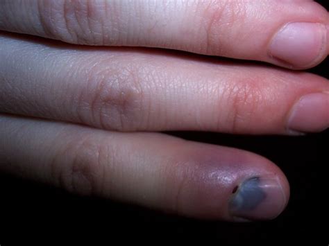Smashed Finger Blogged Ian Kramar Flickr