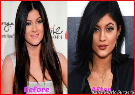 Kylie Jenner Plastic Surgery Transformation Celebrities Plastic Surgery