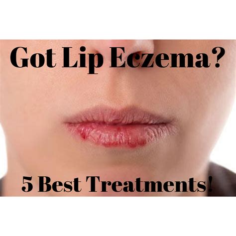 5 Best Treatments For Lip Eczema Eczematous Cheilitis Our Eczema