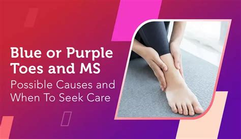 Why Ms Can Cause Purple Toes Or Feet And When To Take Action Mymsteam