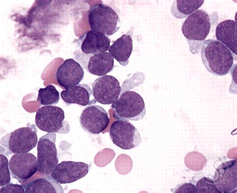 Precursor T Cell Acute Lymphoblastic Leukemia 2