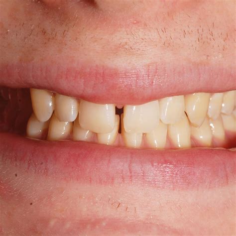 Overbite And Underbite Treatment Face Teeth Smile Gerrards Cross