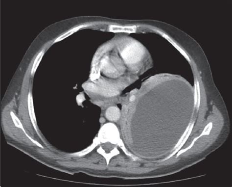 The precise pathophysiology of fluid accumulation varies according to underlying aetiologies. Chest CT revealed a large loculated left pleural effusi ...