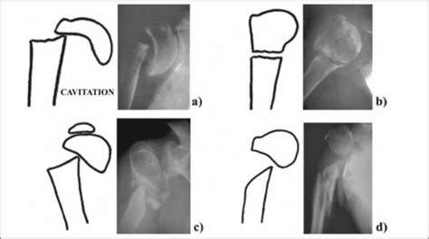 Classification Of Pseudarthrosis Of The Proximal Humerus Into The Four