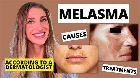 Best Melasma Treatment Dermatologist Explains Melasma Causes At Home