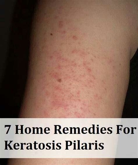 Pin By Ame On Здоровье Skin Remedies Keratosis Pilaris How To Get