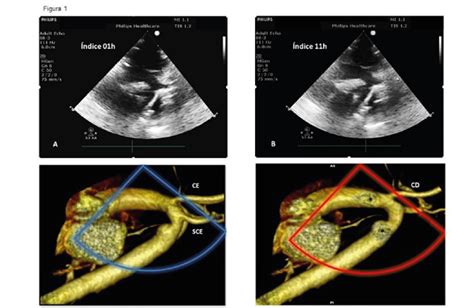 Role Of Transthoracic Echocardiography In The Diagnosis Of Double Aortic Arch Abc Imaging
