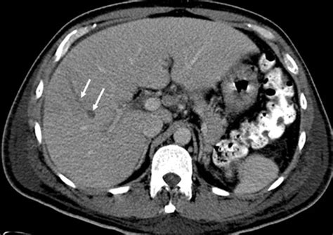 Ct Appearance Of Pyogenic Liver Abscesses Caused By Klebsiella