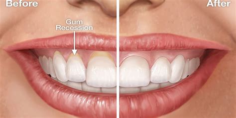 4 Important Points About Receding Gums Causes And Treatments