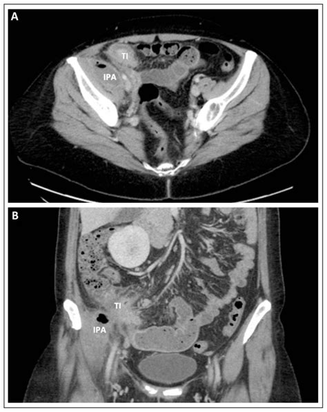 Image Diagnosis Iliopsoas Abscess From Crohn Disease The Permanente