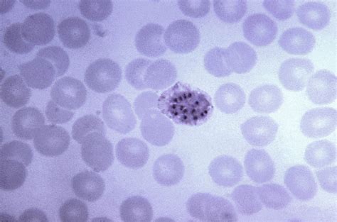 Plasmodium Falciparum Blood Smear
