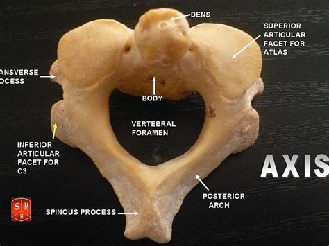 Ossos Atlas E Axis