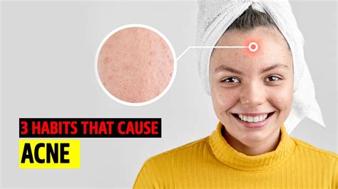 Top 3 Habits That May Cause Acne Youtube