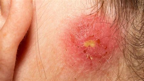 Staph Infection On Skin Causes And Prevention In