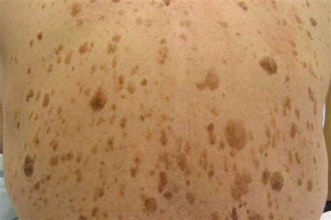 Topical Treatment On Hand For Liver Spots — Harvard Gazette