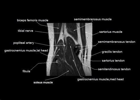 Each anatomical structure was labeled interactively. knee anatomy | MRI knee coronal anatomy | free cross sectional anatomy