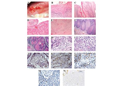 Histological And Molecular Aspects Of Oral Squamous Cell Carcinoma Review