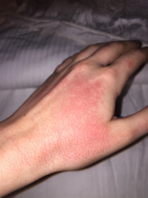Rashes On Hands