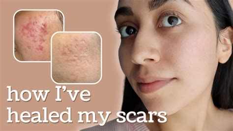 Healing Hyperpigmentation Deep Pitted Acne Scars This Is What Ive
