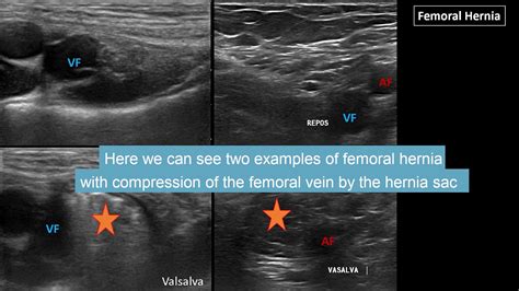 Groin Pain And Ultrasound Part 2 Inguinal Femoral And Sport Hernia