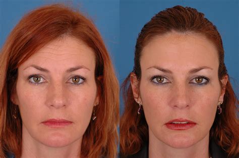 Botox Facelift Before And After