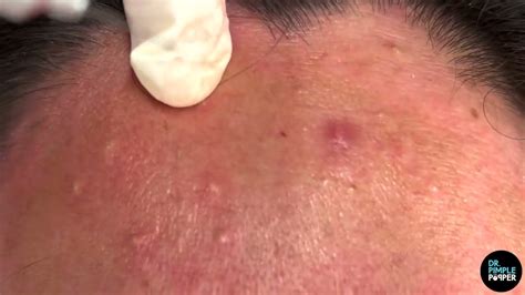 Comedones Galore On Face And Forehead Dr Pimple Popper Pops And Removes