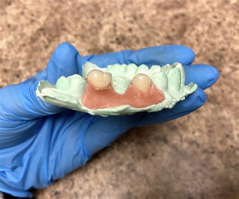 DIY Dentures / Temporary Tooth : 6 Steps - Instructables