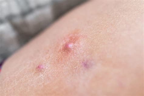 Red Bumps May Be Inflammatory Skin Condition Hidradenitis Suppurative