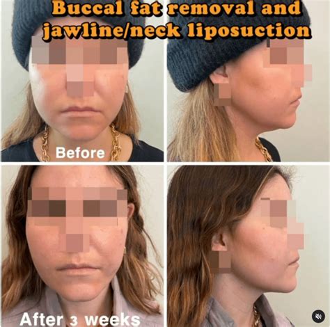 Buccal Fat Pad Removal Harley Clinic
