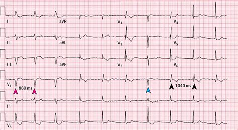 Abnormal Electrocardiogram In A Woman With Atrial Fibrillation Atrial