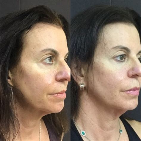 Before And After Cynthia Golomb Md Dermatology Boutique