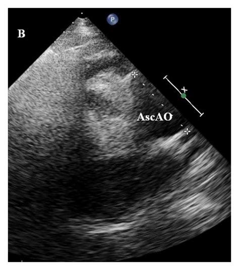 Transthoracic Echocardiogram In Parasternal Long Axis View Showing