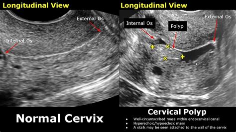 Cervix Ultrasound Normal Vs Abnormal Image Appearances Uterus Pathologies Gynecological Usg
