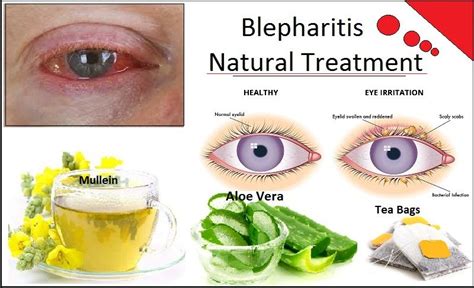 Blepharitis Natural Treatment Inflammation Of The Eyelid Blepharitis