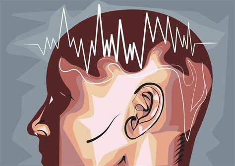 New Eeg Insights Offer Window Into Hypersomnia Differential Diagnosis