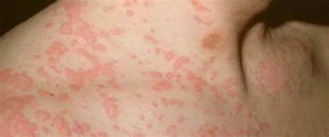 Measles In Adults Causes Symptoms Diagnosis Treatment