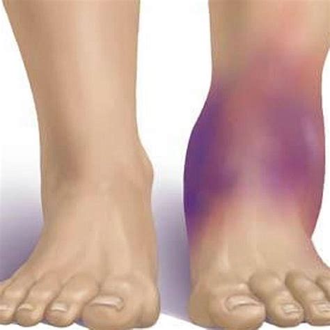 High Ankle Sprain An Uncommon Orthopedic Injury Orthopedic Center For