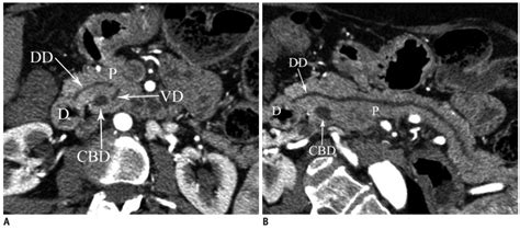 Pancreas Divisum Axial A And Curved Planar Reformatted B Mdct