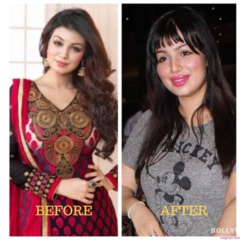 Ayesha Takia Plastic Surgery Photos Before And After ⋆ Surgery4