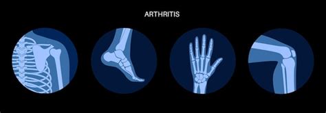 Premium Vector Rheumatoid Arthritis Inflammation Bone Disease Concept