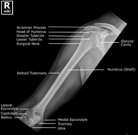 Labeled Humerus Xray Anatomy Ap View Anatomy Radiology Grepmed