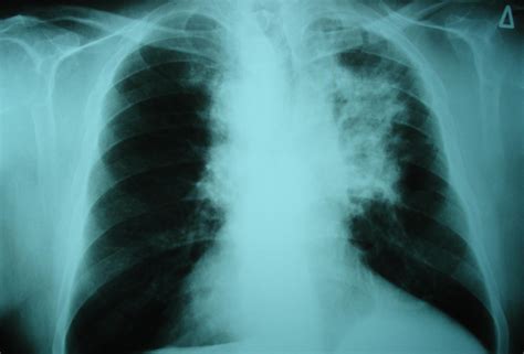 chest xray for diagnosis of lung cancer