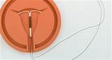 Images of Iud Birth Control Brands